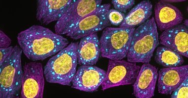 الصحة تكشف أسباب تكاثر الخلايا السرطانية في الجسم .. اعرف التفاصيل