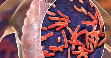 الصحة تعلن زيادة تغطية علاج الدرن إلى 90% بحلول عام 2025