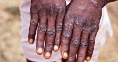 مسئولة بالصحة العالمية: إصابات جدرى القرود الحالية قد تكون مجرد بداية مسئولة بالصحة العالمية: إصابات جدرى القرود الحالية قد تكون مجرد بداية