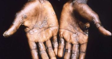 الصحة تكشف معلومات مهمة عن مرض جدرى القرود.. أبرزها: لا ينتقل عبر الهواء