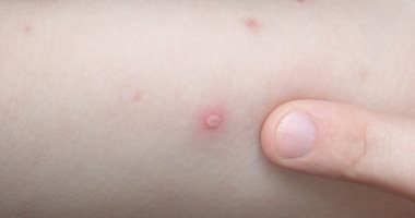 الصحة العالمية تكشف طرق مواجهة عدوى وعلاج جدرى القرود.. اعرف التفاصيل الصحة العالمية تكشف طرق مواجهة عدوى وعلاج جدرى القرود.. اعرف التفاصيل