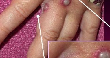 وزارة الصحة الإماراتية تعلن عن رصد أول حالة إصابة بجدري القرود