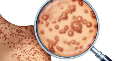 المغرب يعلن رصد 3 حالات مشتبه فى إصابتها بجدرى القردة