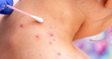 أخبار × 24 ساعة.. الصحة: احتمال انتشار جدرى القرود بالشرق الأوسط غير متوقع أخبار × 24 ساعة.. الصحة: احتمال انتشار جدرى القرود بالشرق الأوسط غير متوقع