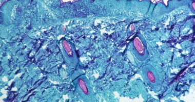 أخبار 24 ساعة.. الصحة: لم يظهر فى مصر أى حالات إصابة بجدرى القرود