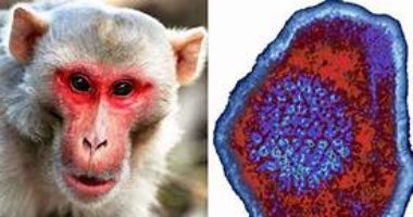 الصحة تكشف أعراض الإصابة بجدرى القرود .. تعرف عليها