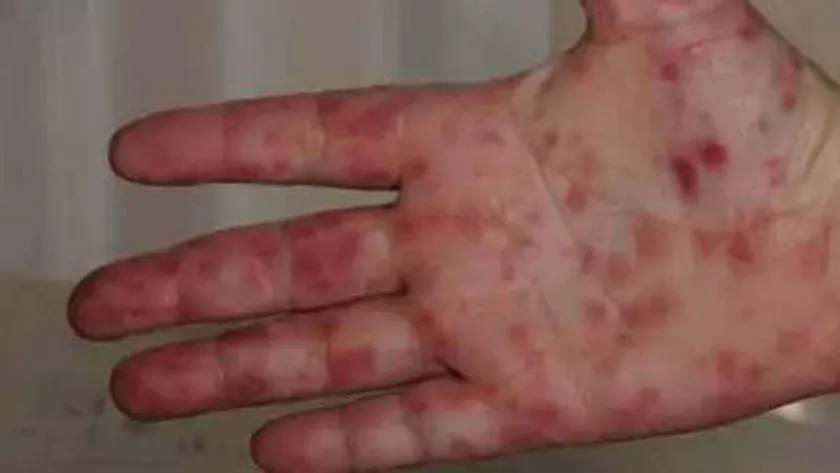 فيروس إنفلونزا الطماطم