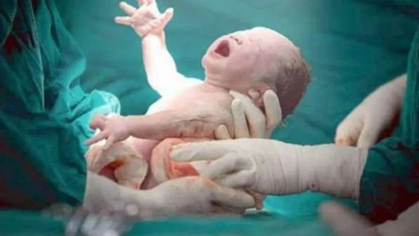 الولادة القصرية تؤثر على صحة الطفل (أرشيفية)